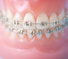 矯正歯科にはどんな治療法があるの？