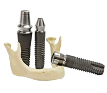 インプラントと天然歯と連結させることは可能？
