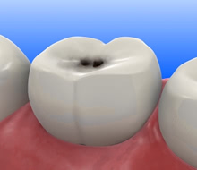 歯並びが悪いと、虫歯になりやすいのは事実