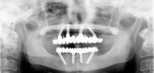 最終補綴物装着後パノラマX線
