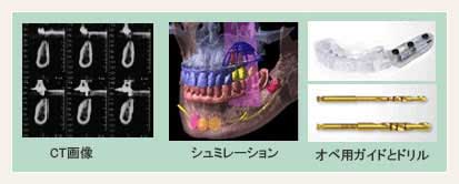 精密検査/CT撮影・シミュレーション