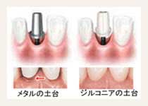 上部構造の作製・装着