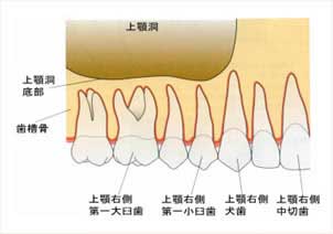 上顎洞底挙上術の解説図