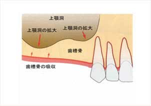 上顎洞底挙上術の解説図