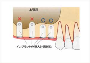 上顎洞底挙上術の解説図