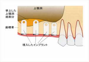 上顎洞底挙上術の解説図