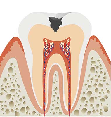 象牙質のむし歯