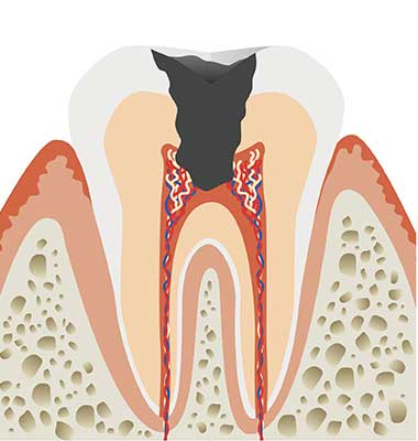 神経に達した虫歯
