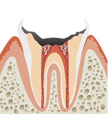 歯根に達した虫歯