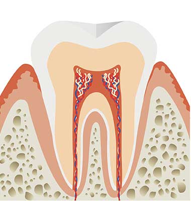 歯根に達した虫歯