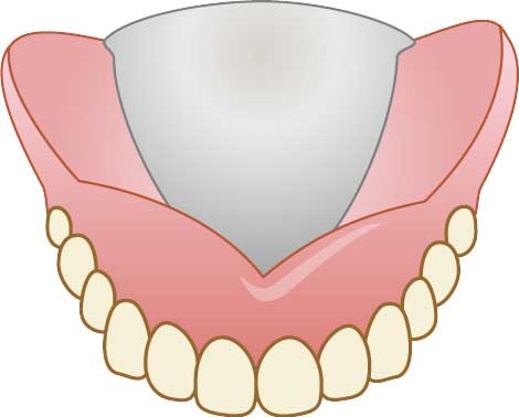 金属床義歯