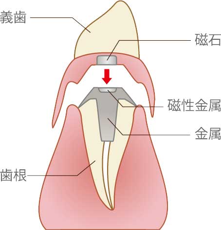 磁性アタッチメント義歯