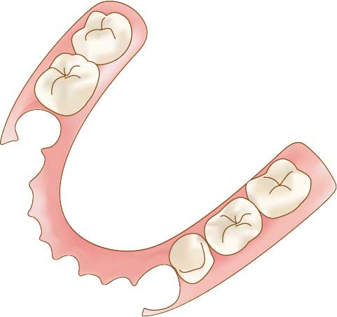 磁性アタッチメント義歯