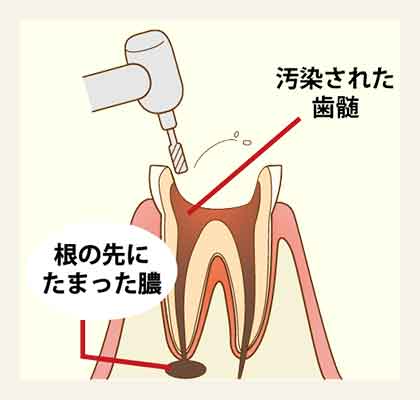 Ni-Ti(ニッケルチタン)ファイルの使用