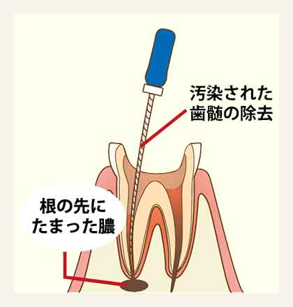 根管内部の清掃・消毒