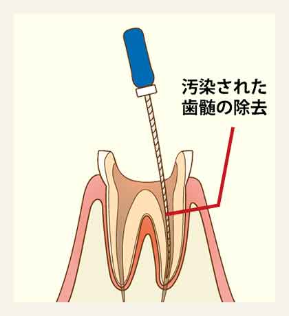 消毒・薬の交換