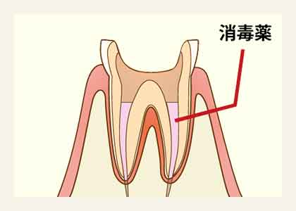 最終的な薬を詰めて終了