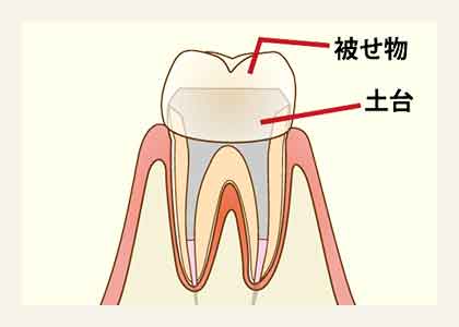 かぶせ物の治療へ