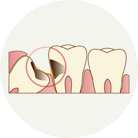 虫歯ができている