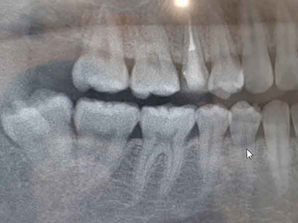 口腔外科のドクターがいる歯科で抜歯する
