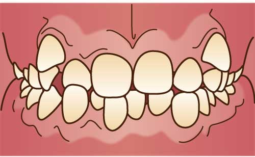 デコボコ・ガタガタの歯並び