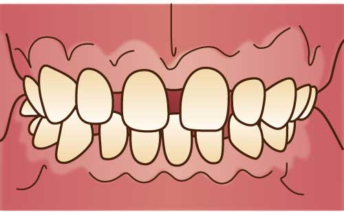 すきっ歯