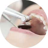 歯垢・歯石除去、除菌プログラム